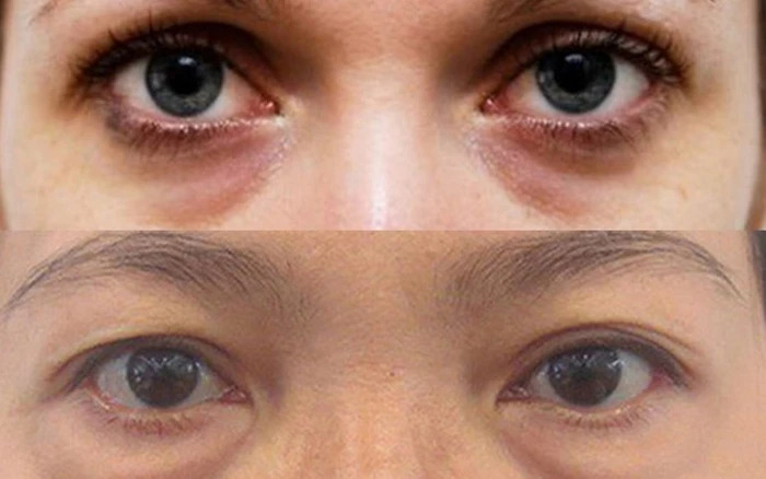 Lão hóa da vùng mắt - Lão hóa da vùng mắt - Quầng thâm và bọng mắt