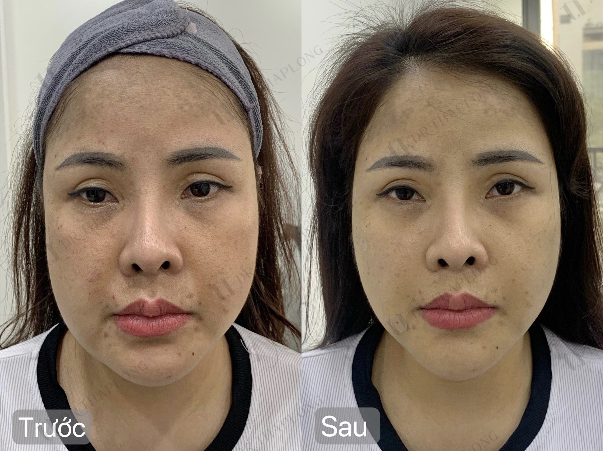 Tiêm botox filler không ưng ý